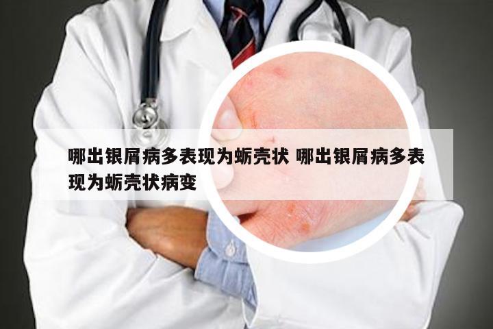 哪出银屑病多表现为蛎壳状 哪出银屑病多表现为蛎壳状病变