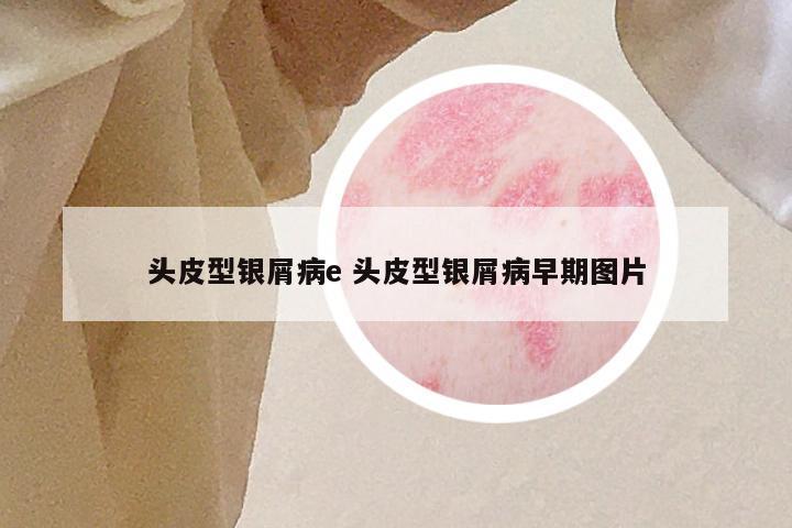 头皮型银屑病e 头皮型银屑病早期图片