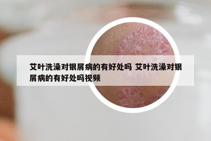 艾叶洗澡对银屑病的有好处吗 艾叶洗澡对银屑病的有好处吗视频