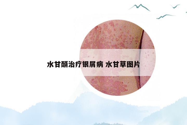 水甘醑治疗银屑病 水甘草图片