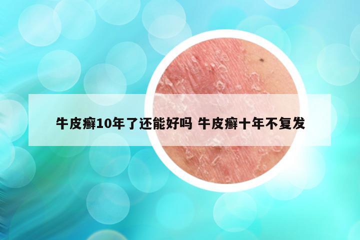 牛皮癣10年了还能好吗 牛皮癣十年不复发