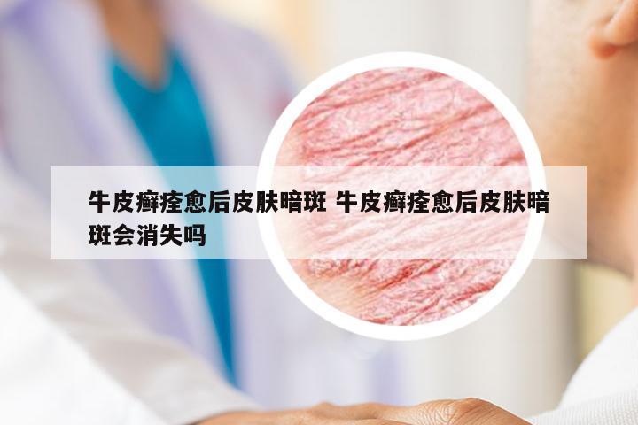 牛皮癣痊愈后皮肤暗斑 牛皮癣痊愈后皮肤暗斑会消失吗