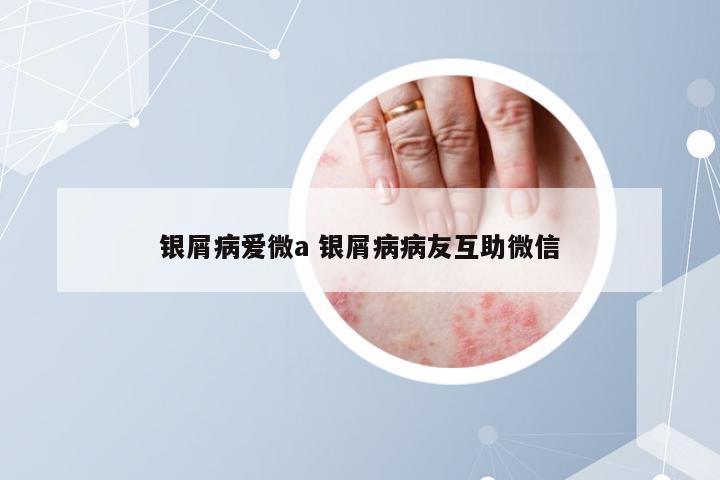 银屑病爱微a 银屑病病友互助微信