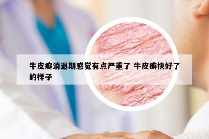 牛皮癣消退期感觉有点严重了 牛皮癣快好了的样子