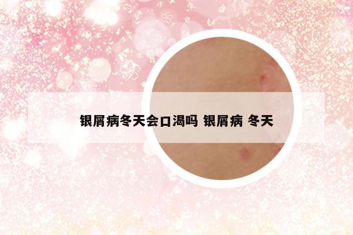 银屑病冬天会口渴吗 银屑病 冬天