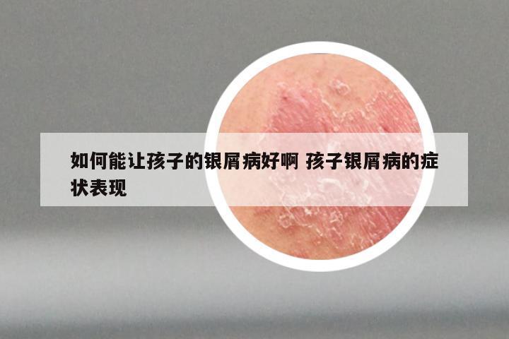 如何能让孩子的银屑病好啊 孩子银屑病的症状表现