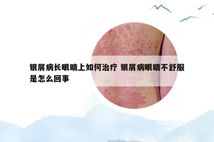 银屑病长眼睛上如何治疗 银屑病眼睛不舒服是怎么回事