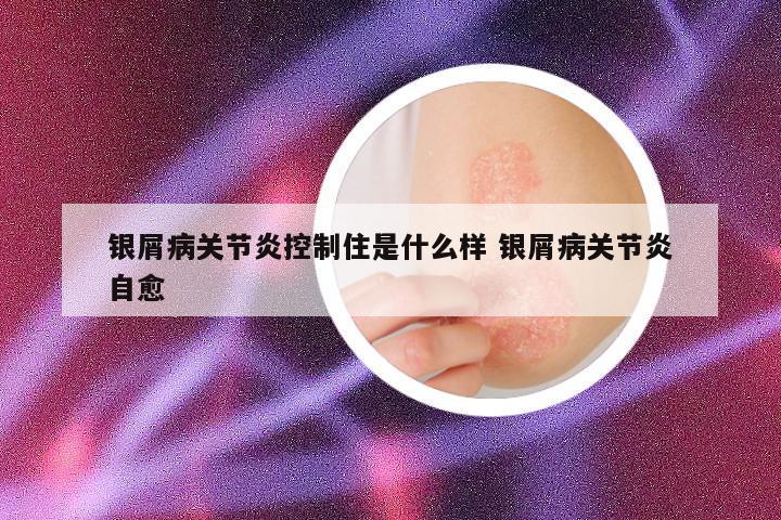 银屑病关节炎控制住是什么样 银屑病关节炎自愈