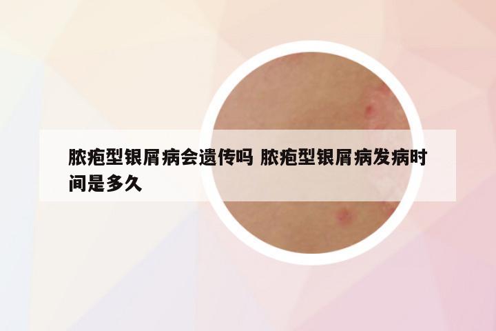 脓疱型银屑病会遗传吗 脓疱型银屑病发病时间是多久