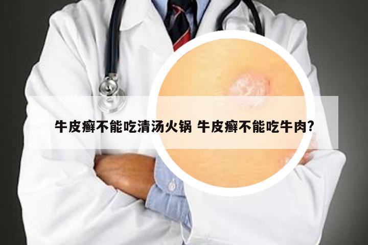 牛皮癣不能吃清汤火锅 牛皮癣不能吃牛肉?