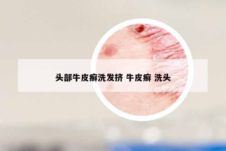 头部牛皮癣洗发挤 牛皮癣 洗头
