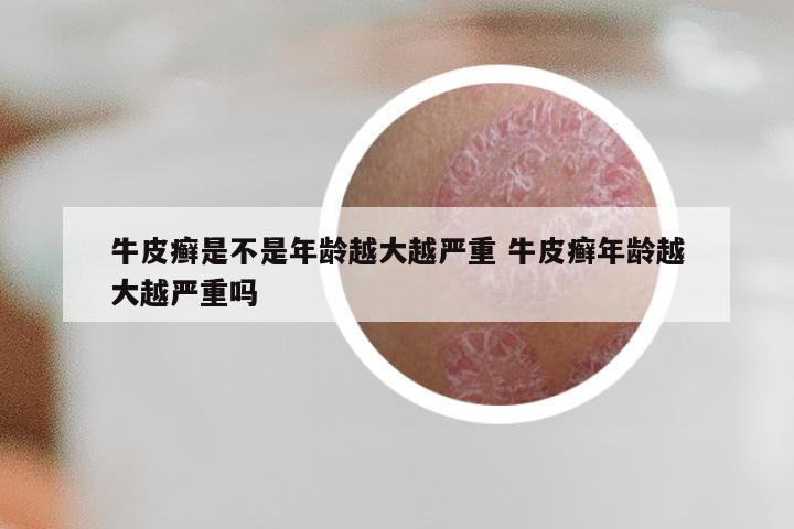 牛皮癣是不是年龄越大越严重 牛皮癣年龄越大越严重吗