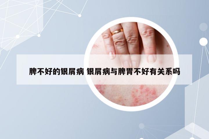 脾不好的银屑病 银屑病与脾胃不好有关系吗