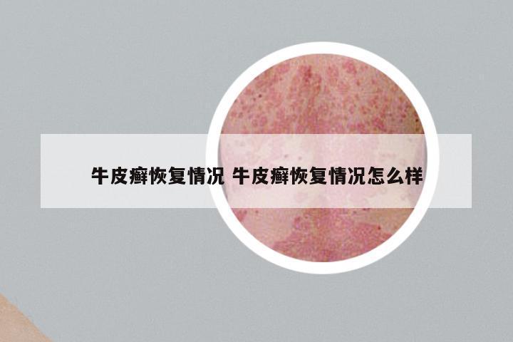 牛皮癣恢复情况 牛皮癣恢复情况怎么样