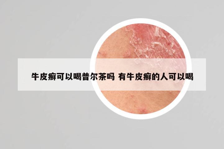 牛皮癣可以喝普尔茶吗 有牛皮癣的人可以喝