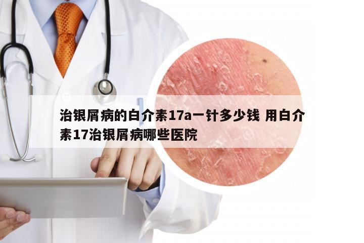 治银屑病的白介素17a一针多少钱 用白介素17治银屑病哪些医院