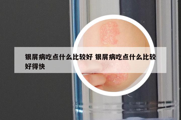 银屑病吃点什么比较好 银屑病吃点什么比较好得快