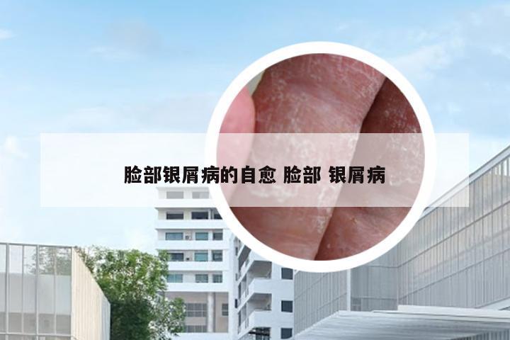 脸部银屑病的自愈 脸部 银屑病