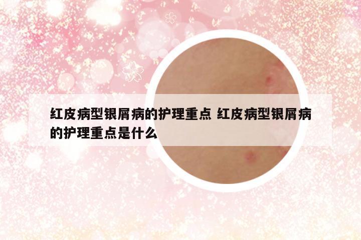 红皮病型银屑病的护理重点 红皮病型银屑病的护理重点是什么