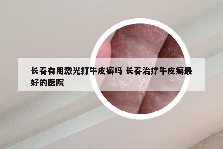 长春有用激光打牛皮癣吗 长春治疗牛皮癣最好的医院