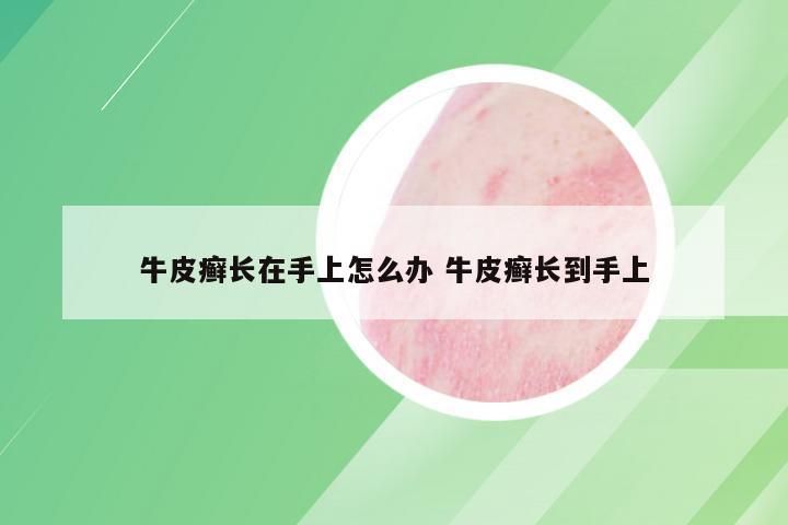 牛皮癣长在手上怎么办 牛皮癣长到手上