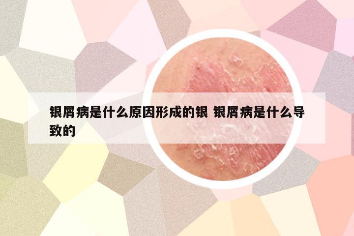 银屑病是什么原因形成的银 银屑病是什么导致的