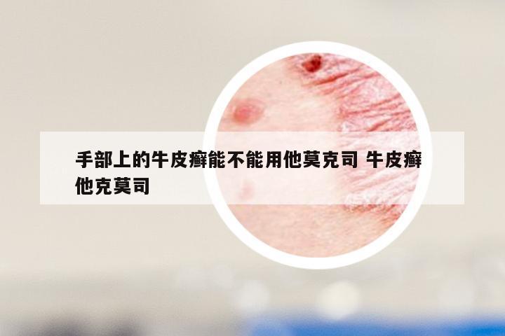 手部上的牛皮癣能不能用他莫克司 牛皮癣 他克莫司