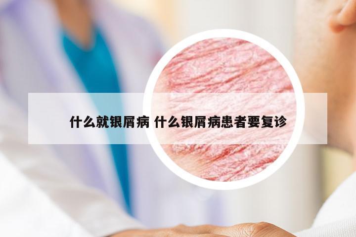 什么就银屑病 什么银屑病患者要复诊