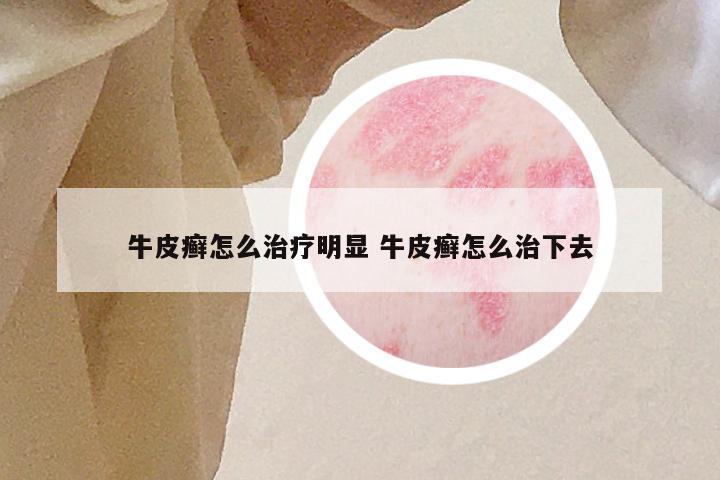 牛皮癣怎么治疗明显 牛皮癣怎么治下去