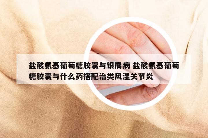 盐酸氨基葡萄糖胶囊与银屑病 盐酸氨基葡萄糖胶囊与什么药搭配治类风湿关节炎