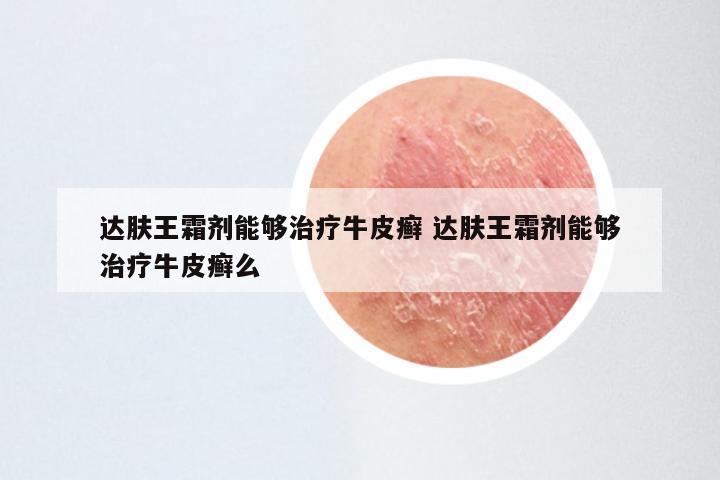 达肤王霜剂能够治疗牛皮癣 达肤王霜剂能够治疗牛皮癣么