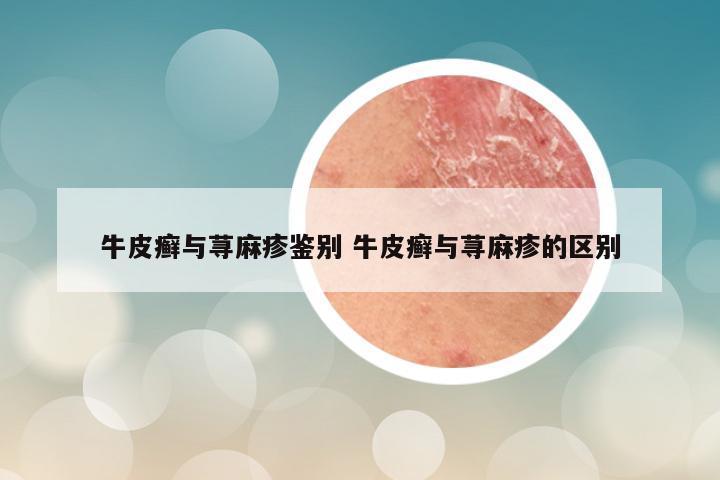 牛皮癣与荨麻疹鉴别 牛皮癣与荨麻疹的区别
