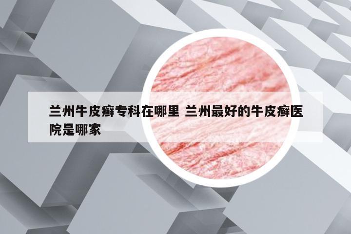 兰州牛皮癣专科在哪里 兰州最好的牛皮癣医院是哪家