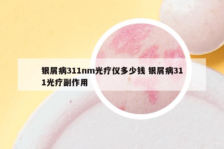 银屑病311nm光疗仪多少钱 银屑病311光疗副作用