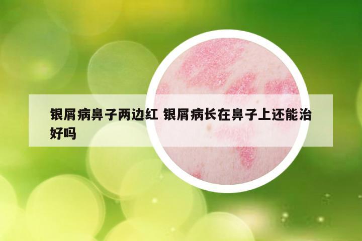 银屑病鼻子两边红 银屑病长在鼻子上还能治好吗