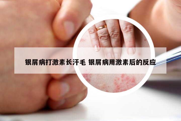 银屑病打激素长汗毛 银屑病用激素后的反应