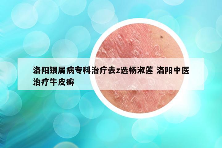 洛阳银屑病专科治疗去z选杨淑莲 洛阳中医治疗牛皮癣