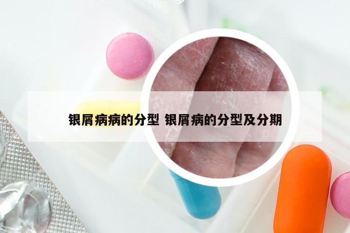 银屑病病的分型 银屑病的分型及分期