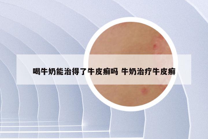 喝牛奶能治得了牛皮癣吗 牛奶治疗牛皮癣