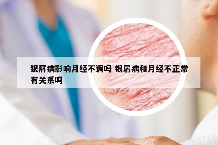 银屑病影响月经不调吗 银屑病和月经不正常有关系吗