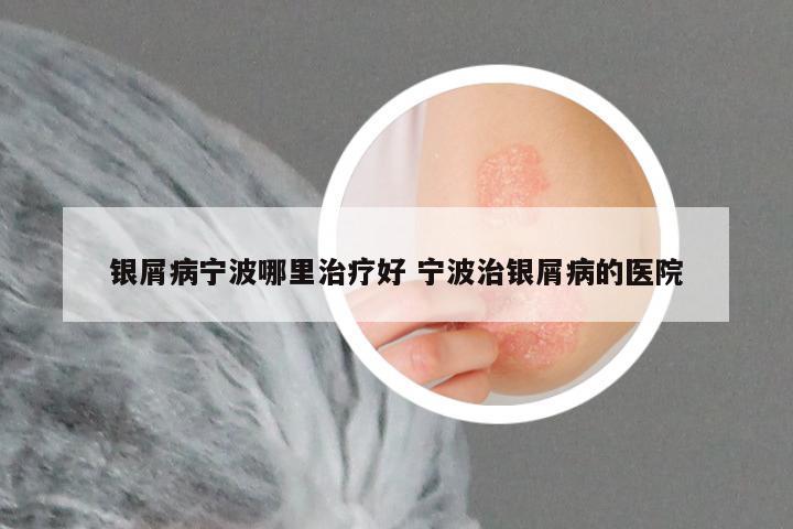 银屑病宁波哪里治疗好 宁波治银屑病的医院