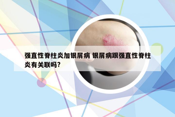 强直性脊柱炎加银屑病 银屑病跟强直性脊柱炎有关联吗?