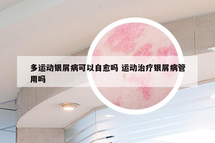 多运动银屑病可以自愈吗 运动治疗银屑病管用吗