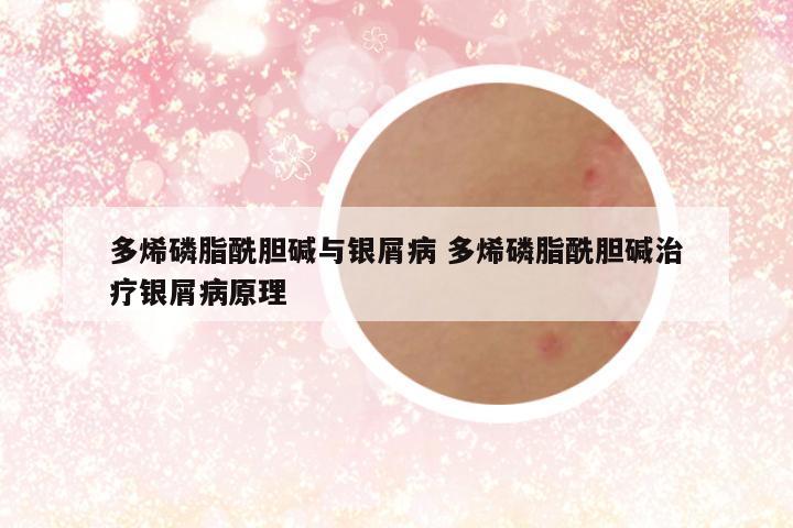 多烯磷脂酰胆碱与银屑病 多烯磷脂酰胆碱治疗银屑病原理