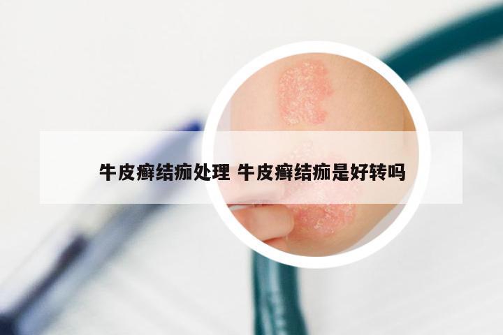 牛皮癣结痂处理 牛皮癣结痂是好转吗