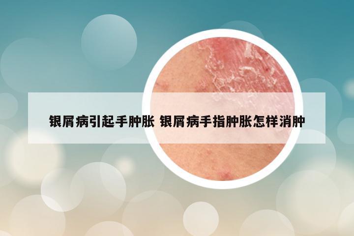 银屑病引起手肿胀 银屑病手指肿胀怎样消肿