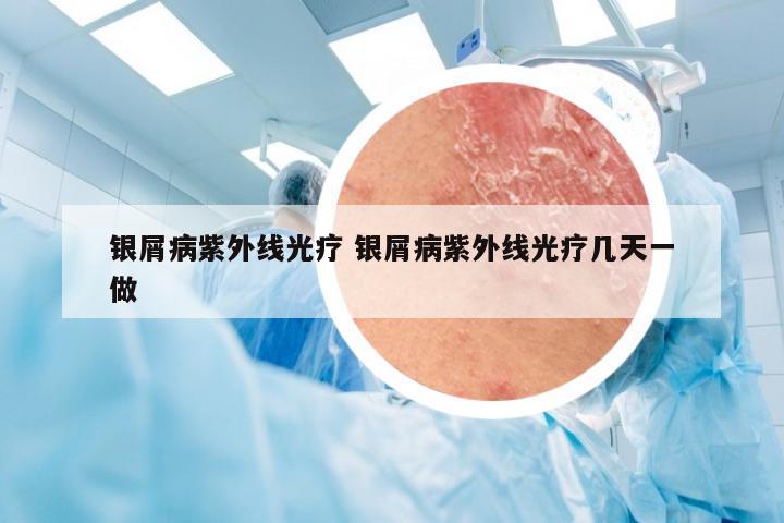 银屑病紫外线光疗 银屑病紫外线光疗几天一做