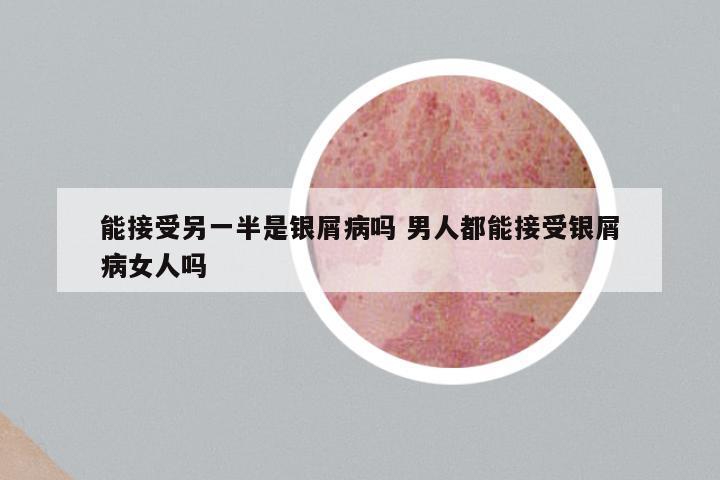 能接受另一半是银屑病吗 男人都能接受银屑病女人吗