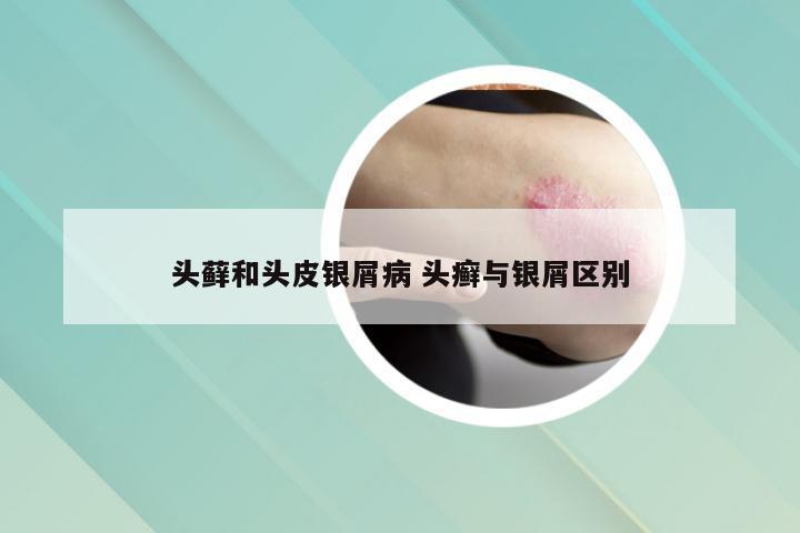 头藓和头皮银屑病 头癣与银屑区别