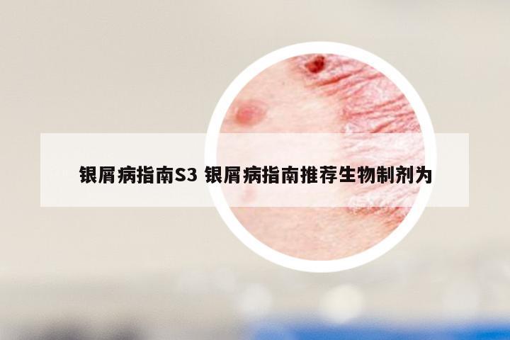 银屑病指南S3 银屑病指南推荐生物制剂为